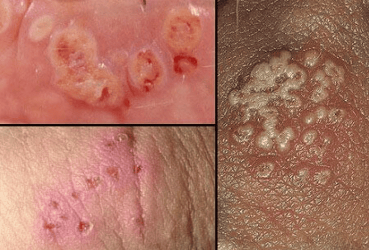 Gonorrhea (सूजाक)