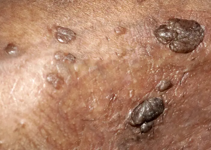 HPV (Genital Warts)