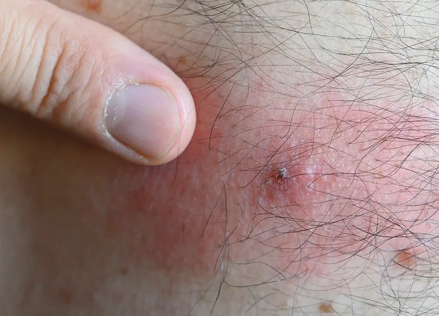Pubic Lice / Scabies