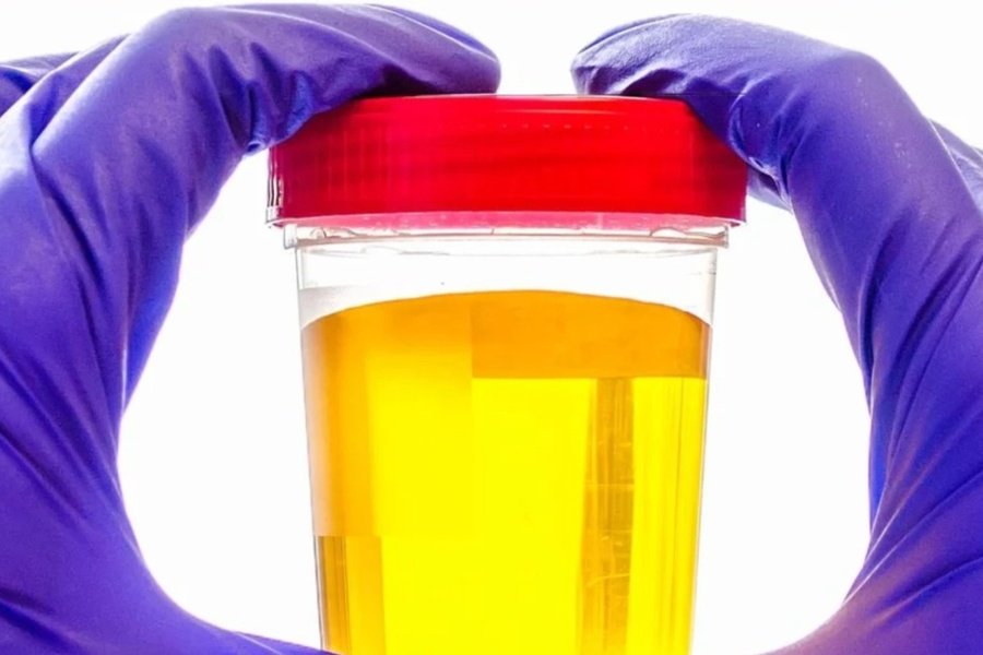 Urine sample में पीले रंग का health awareness image