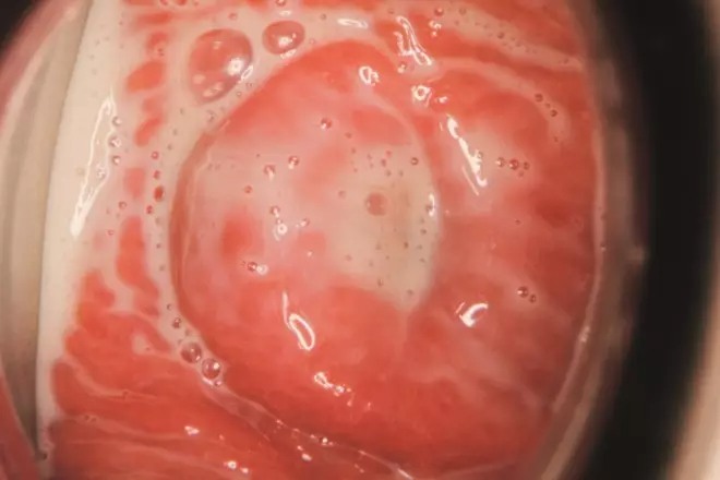 Trichomoniasis